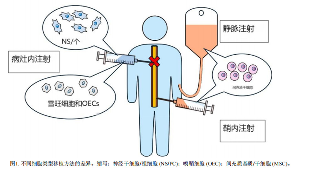干細(xì)胞治療脊髓損傷 干細(xì)胞治療脊髓損傷