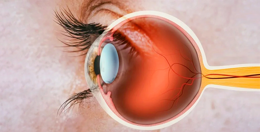 視神經(jīng)疾病 視神經(jīng)疾病