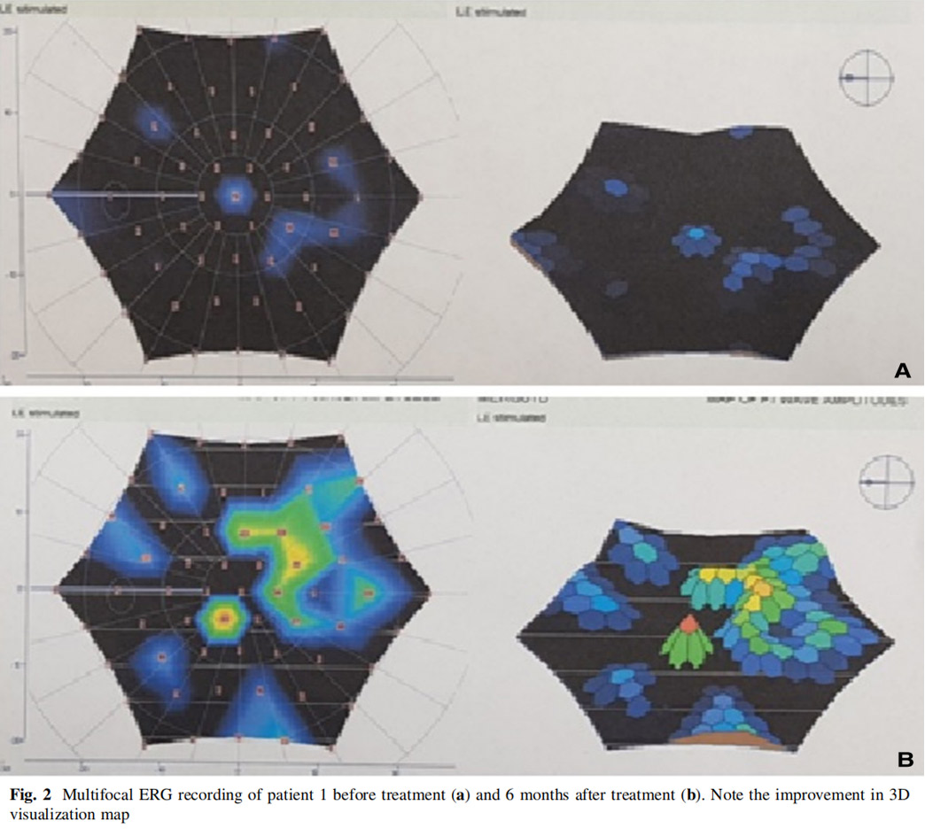 視神經(jīng)萎縮臨床試驗 視神經(jīng)萎縮臨床試驗