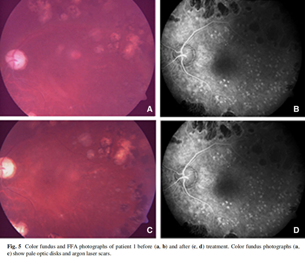 視神經(jīng)萎縮臨床試驗 視神經(jīng)萎縮臨床試驗