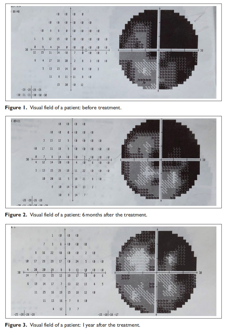 視神經(jīng)萎縮臨床試驗(yàn) 視神經(jīng)萎縮臨床試驗(yàn)