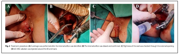 克羅恩病 克羅恩病