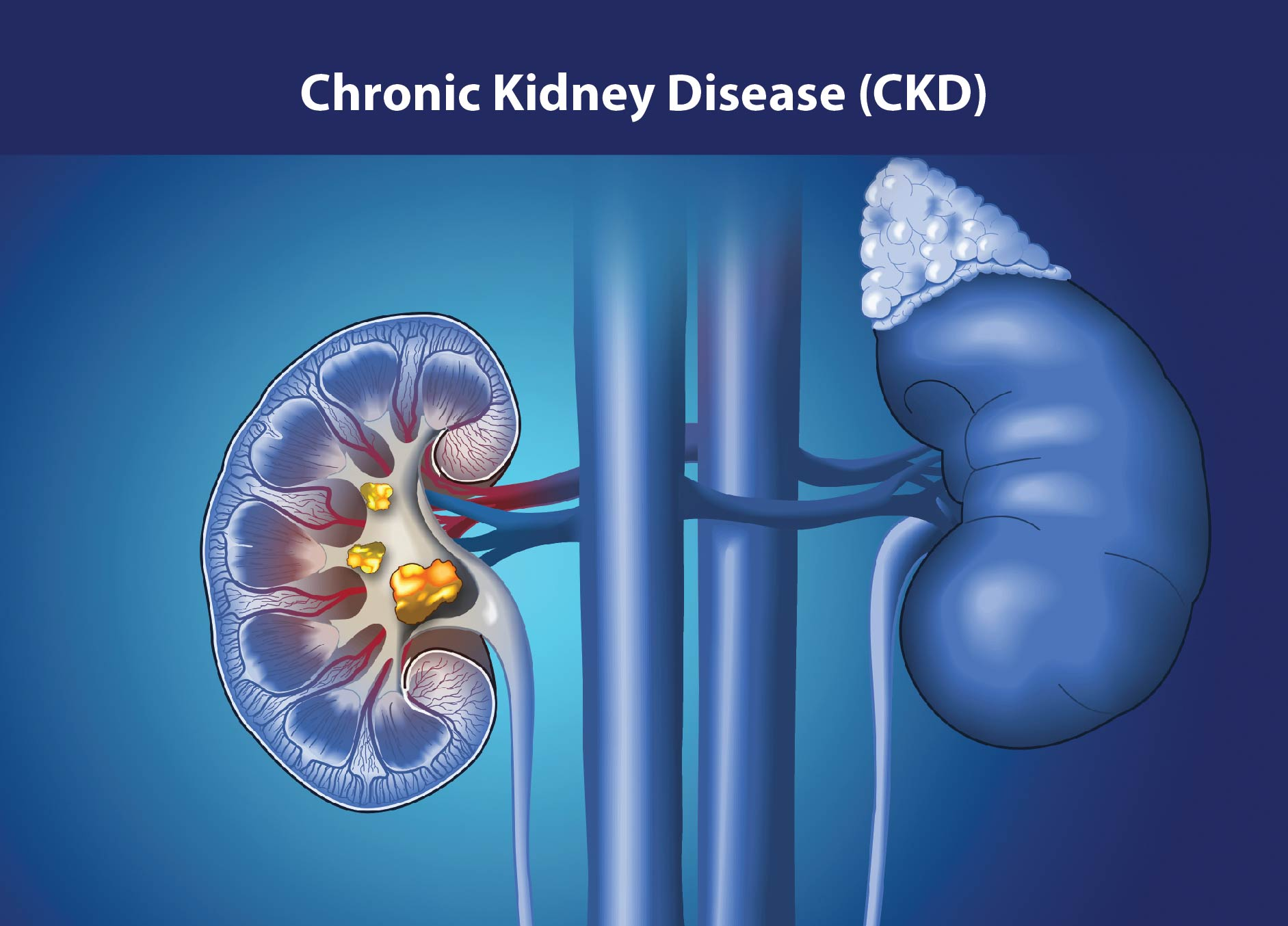 慢性腎病治療新策略：間充質(zhì)干細(xì)胞如何修復(fù)腎功能、延緩疾病進(jìn)展？