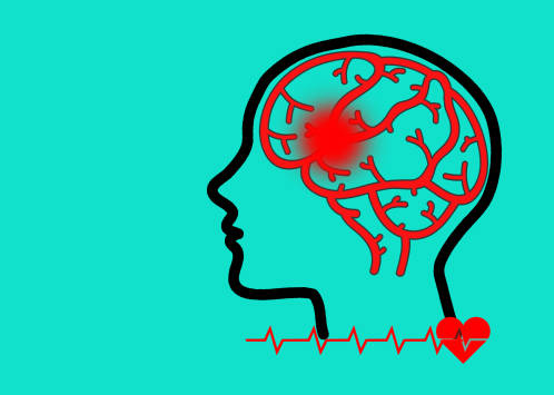 哪些中風(fēng)患者適合干細(xì)胞治療？專家公布了5大評(píng)估標(biāo)準(zhǔn)