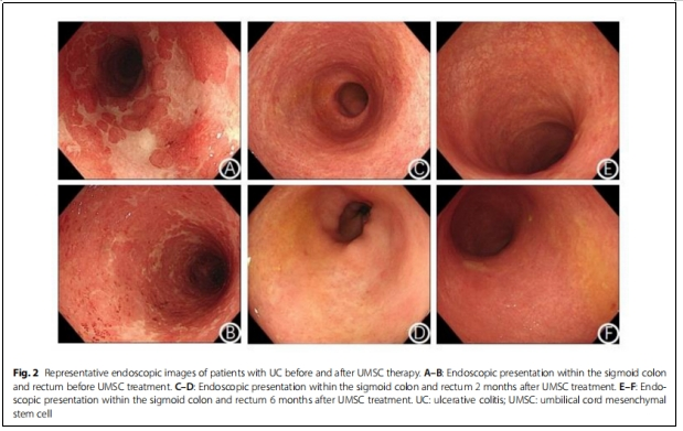 圖2：潰瘍性結(jié)腸炎患者接受UMSC治療前后內(nèi)鏡檢查的典型圖像