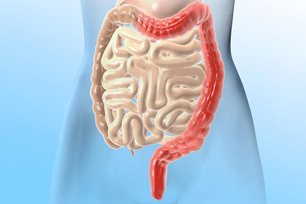 潰瘍性結(jié)腸炎新希望：干細(xì)胞移植2個(gè)月緩解率達(dá)7成，4成患者實(shí)現(xiàn)粘膜愈合