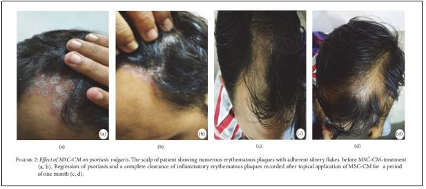 圖2：MSC-CM對(duì)尋常型銀屑病的影響。