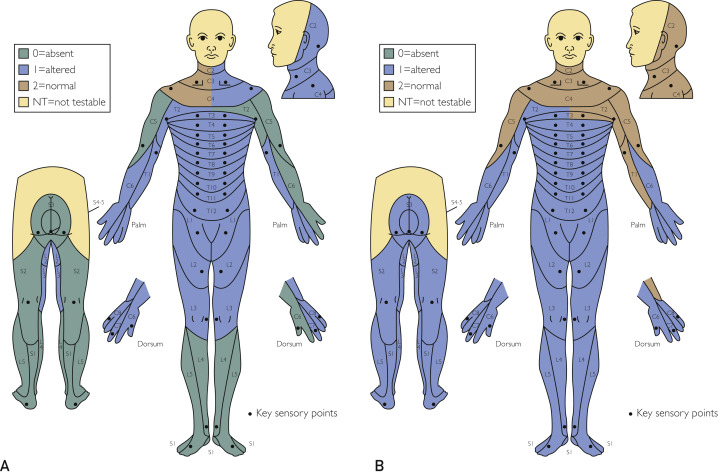 圖2：根據(jù)脊髓損傷神經(jīng)學分類國際標準，在基線（A）和 18 個月隨訪（B）時形成的皮節(jié)感覺評分。