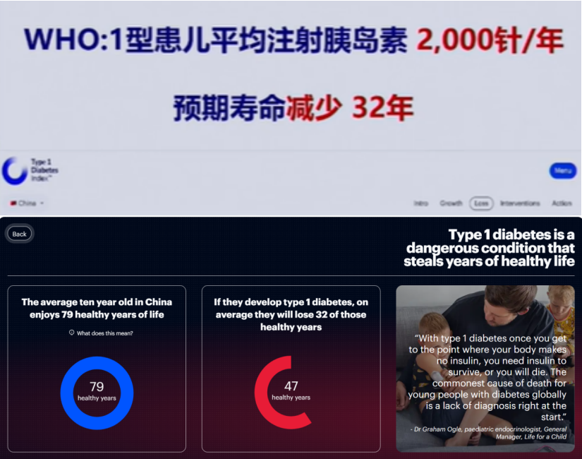 2025｜間充質(zhì)干細胞療法治療1型糖尿?。含F(xiàn)狀與臨床進展