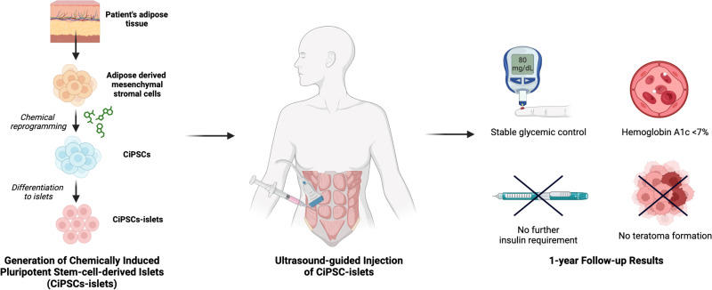 圖示：?通過將患者脂肪組織提取的間充質(zhì)干細(xì)胞化學(xué)重編程為誘導(dǎo)多能干細(xì)胞并分化為胰島，再注射入腹直肌前鞘。