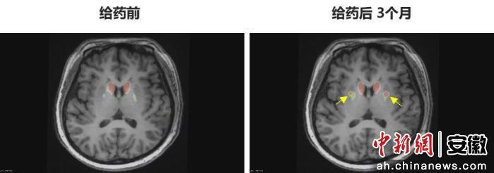 圖為李女士 PET-DAT/MRI融合圖像術(shù)前與術(shù)后三個(gè)月對(duì)比。