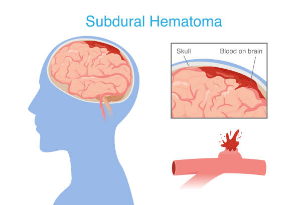 神經(jīng)干細(xì)胞移植治療腦出血的系統(tǒng)評價：NSC來源、輸送途徑、治療機(jī)制和早期臨床試驗(yàn)
