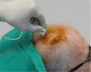 干細(xì)胞注射到大腦過程。