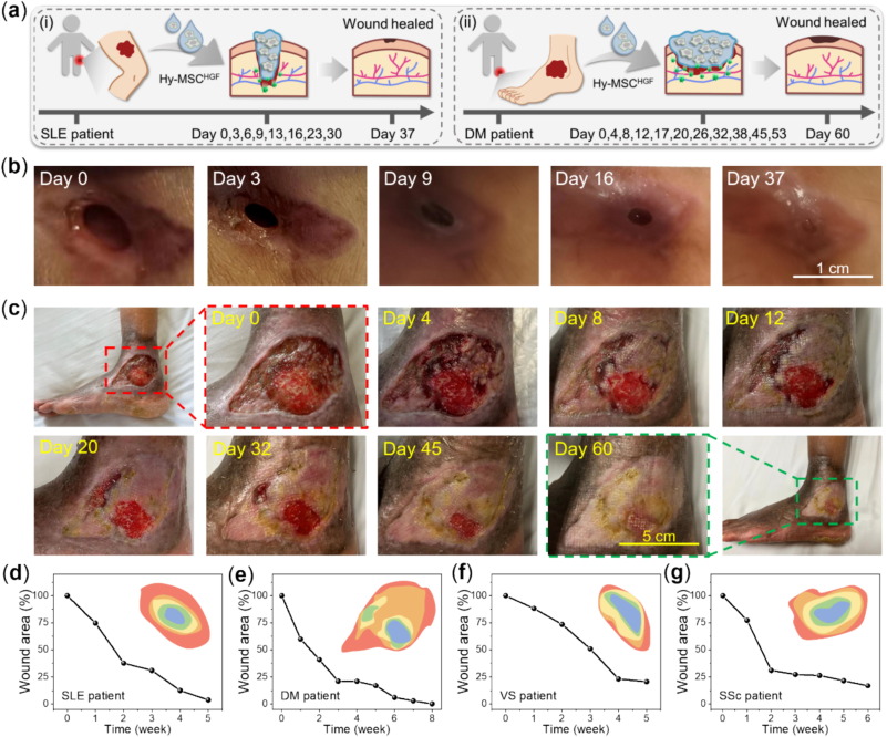 圖：MSC-HGF負(fù)載水凝膠在臨床上治愈人類RW傷口。
